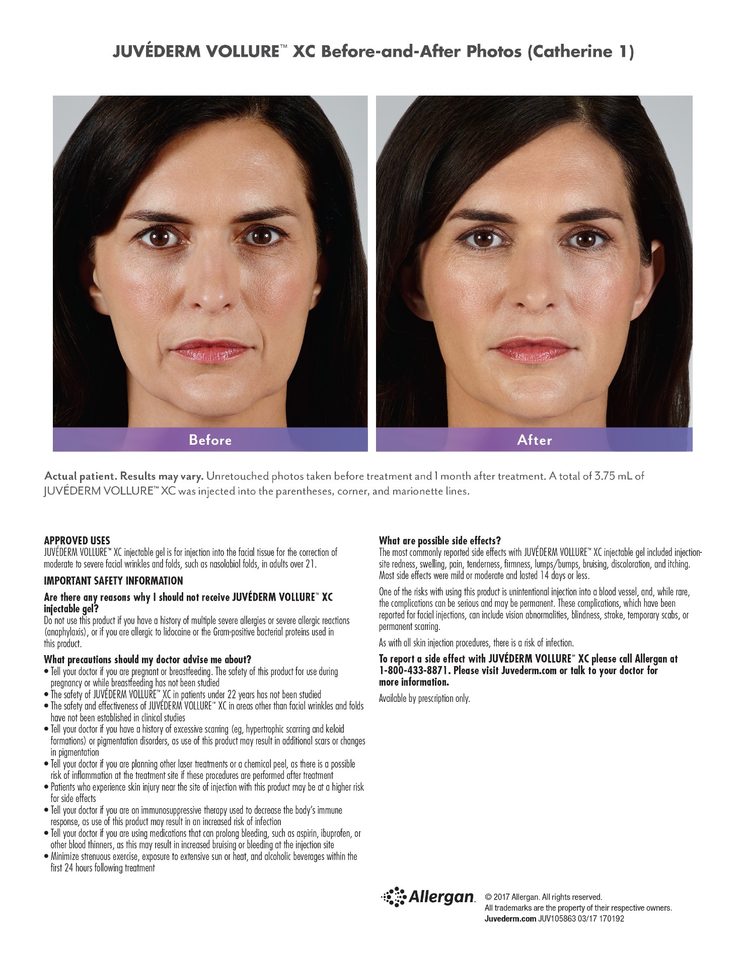 Juvederm Fillers Dr Susan Geerlings